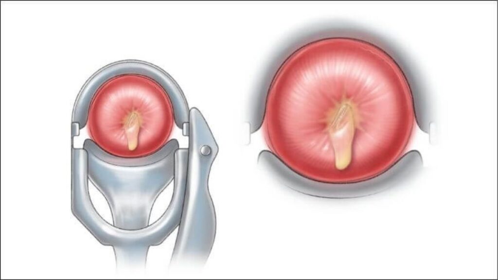 Viêm cổ tử cung lộ tuyến và polyp gây chảy máu sau quan hệ